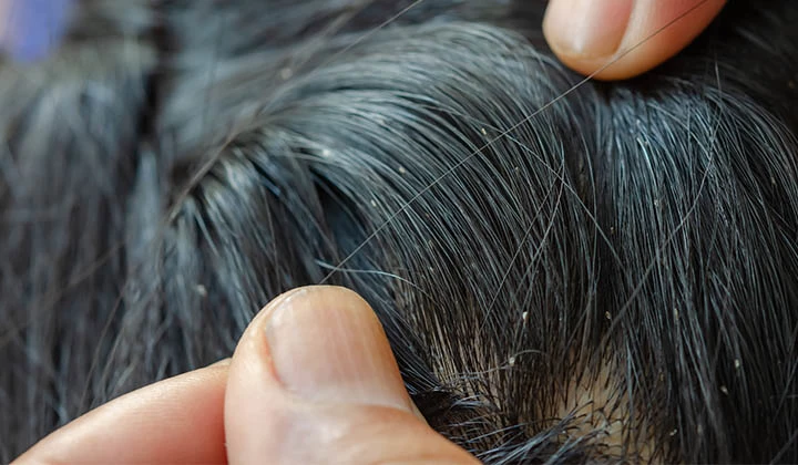 Nissen kleben am Haar Nissen kleben an den Haaren und Kopfhaut